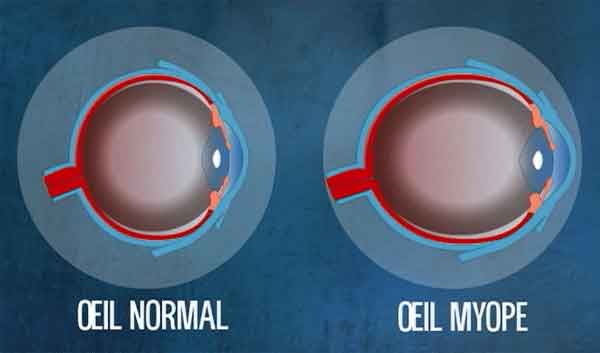 Myopie : oeil myope